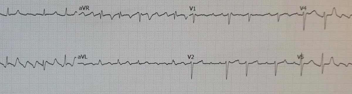 electrocardiogramme